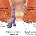 Prolapsed Hemorrhoids: Causes, Symptoms, and Treatment prolapsed hemorrhoids