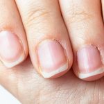 Psoriatic Arthritis Nails: Understanding Symptoms and Nail Health psoriatic arthritis nails"