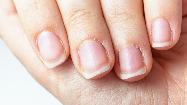 psoriatic arthritis nails"