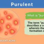 purulent drainage