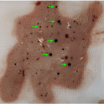 purulent drainage pictures 01