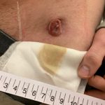 purulent drainage pictures 02