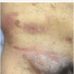 purulent drainage pictures 04