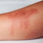 Dealing with Radiation Burn: Causes, Prevention, and Care radiation burn