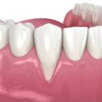 Gums Treatment: Restoring Your Dental Health receding gums treatment