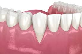 receding gums treatment