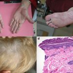 Remicade Side Effects: What You Need to Know remicade side effects