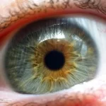 Comprehensive Guide to Retinoschisis: Causes, Symptoms, and Management retinoschisis