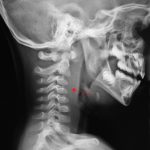 Retropharyngeal Abscess: Causes, Symptoms, and Treatment Explained retropharyngeal abscess