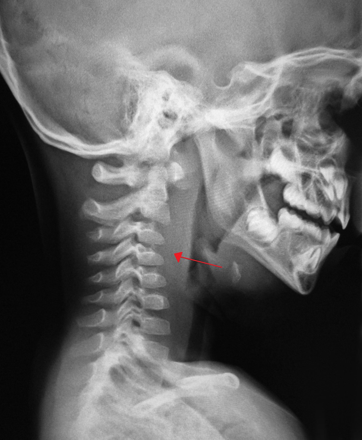 retropharyngeal abscess