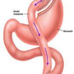 Roux-en-Y Gastric Bypass: A Comprehensive Guide to Weight Loss Surgery roux en y gastric bypass