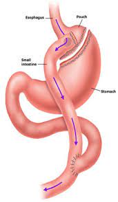 roux en y gastric bypass