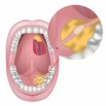 Dealing with Salivary Gland Stones: Causes, Symptoms, and Solutions salivary gland stone