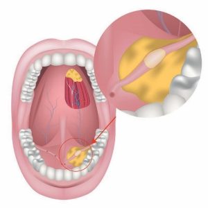 salivary gland stone