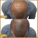 Confidence: The Art of Scalp Micropigmentation scalp micropigmentation