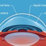 Clearer Vision and Comfort: Exploring the Benefits of Scleral Lenses scleral lenses