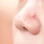 Cancer on Nose: Causes, Symptoms, and Treatment skin cancer on nose
