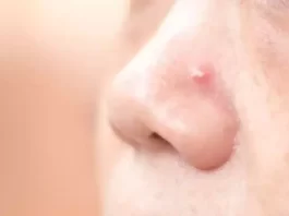 skin cancer on nose