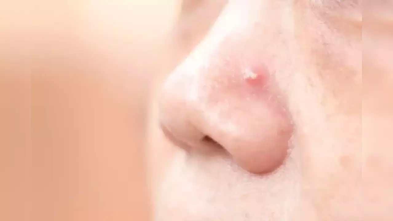 skin cancer on nose
