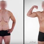 Transform Your Body: The Ultimate Guide to Skin Removal Surgery skin removal surgery