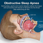 Exploring Sleep Apnea Surgery: Procedures, Benefits, and Considerations sleep apnea surgery