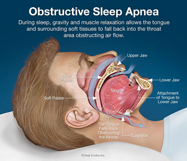 sleep apnea surgery