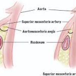 Demystifying Spinal Muscular Atrophy (SMA) Syndrome: Causes, Symptoms, and Treatment sma syndrome