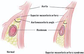 sma syndrome