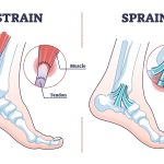 Decoding the Difference: Sprain vs Strain – Understanding Common Injuries sprain vs strain