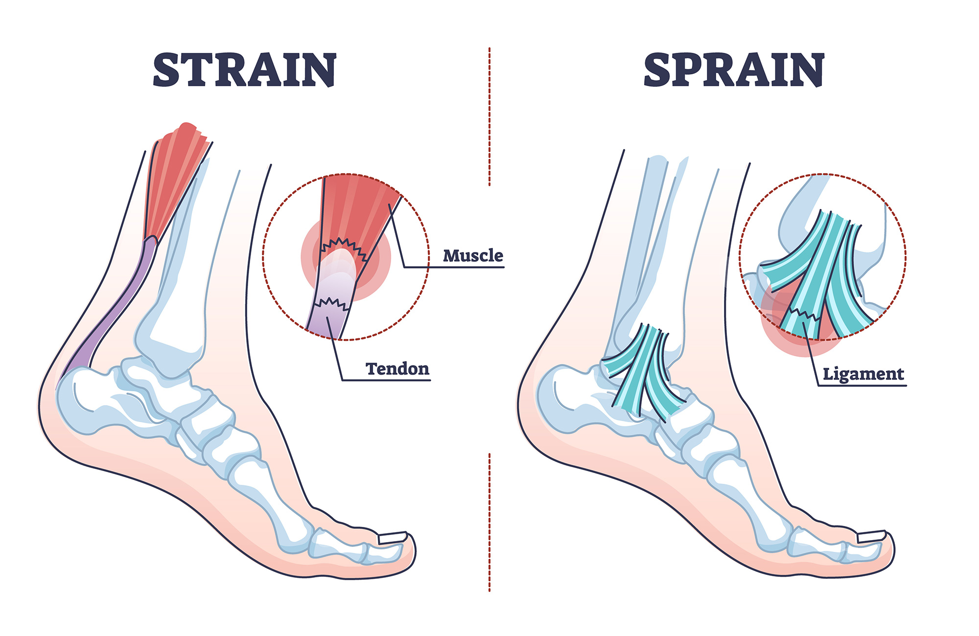 sprain vs strain