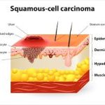 Squamous Cell Carcinoma Treatment: Options, Success Rates, and Recovery squamous cell carcinoma treatment