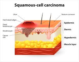 squamous cell carcinoma treatment