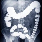 Dealing with Stage 4 Colon Cancer: Hope, Treatment, and Resilience stage 4 colon cancer