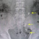 Stages of Passing a Kidney Stone: From Discomfort to Relief stages of passing a kidney stone