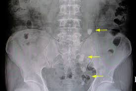 stages of passing a kidney stone