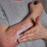 The Uncomfortable Journey: Navigating Through the Stages of Shingles stages of shingles