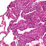 The Enigma: Synovial Sarcoma – Causes, Symptoms, and Treatment synovial sarcoma