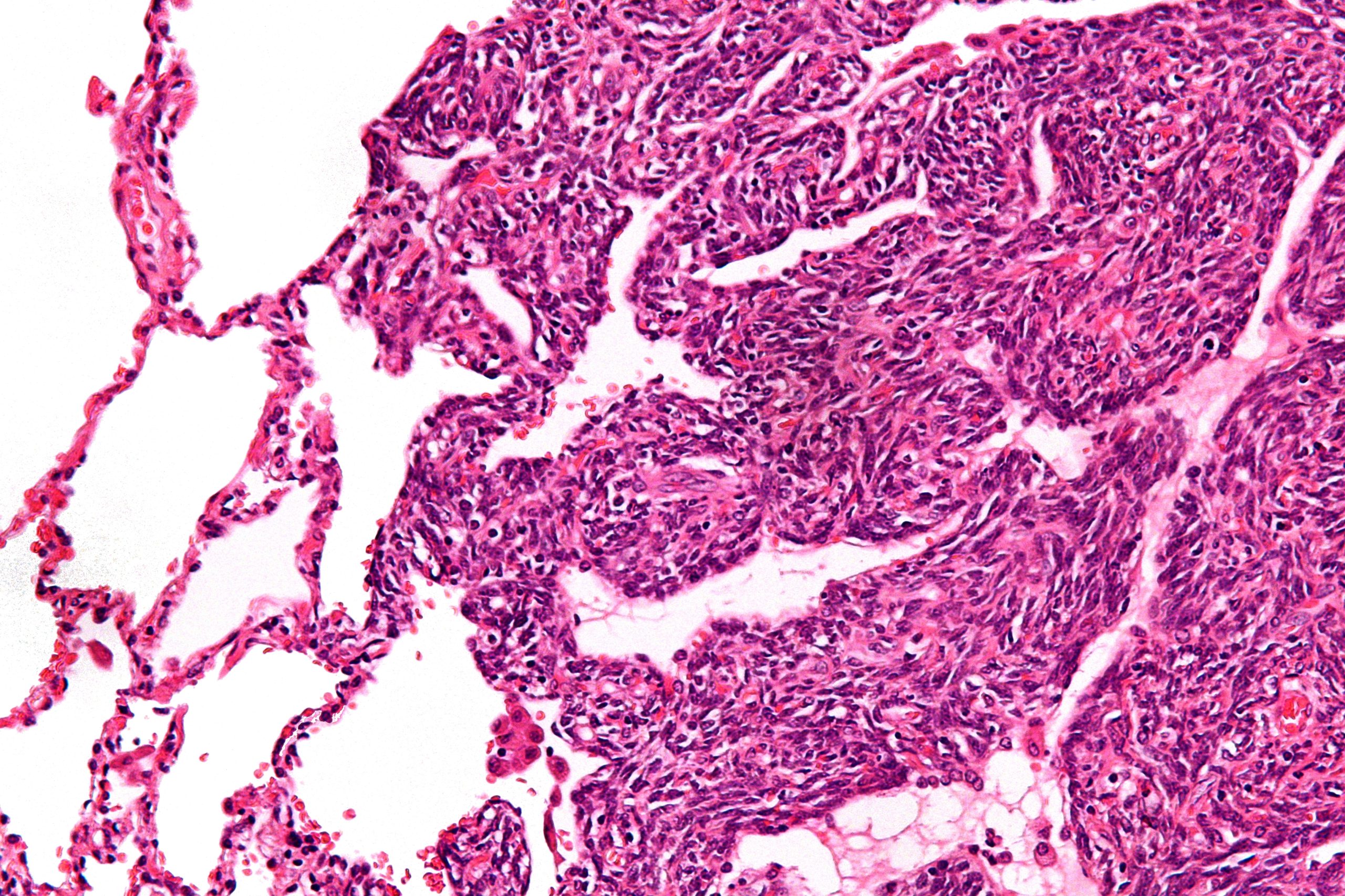 synovial sarcoma