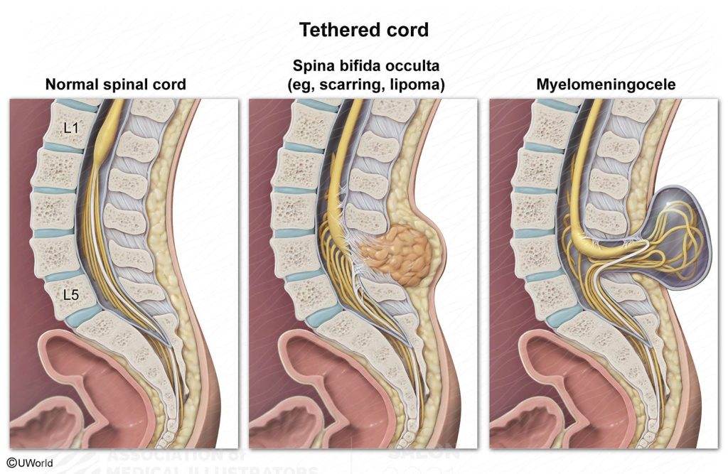 Engaged Spine The Mysteries of Tethered Spinal Cord