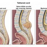 The Mysteries of Tethered Spinal Cord tethered spinal cord