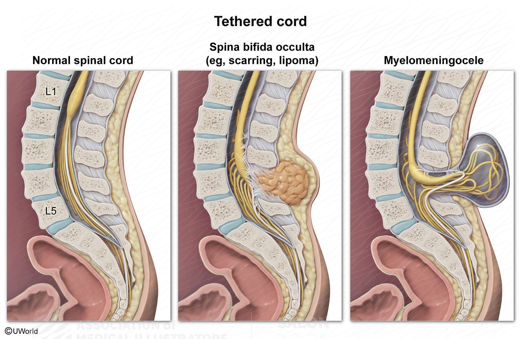 tethered spinal cord