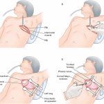 Exploring Thoracotomy: Procedure, Recovery, and Considerations