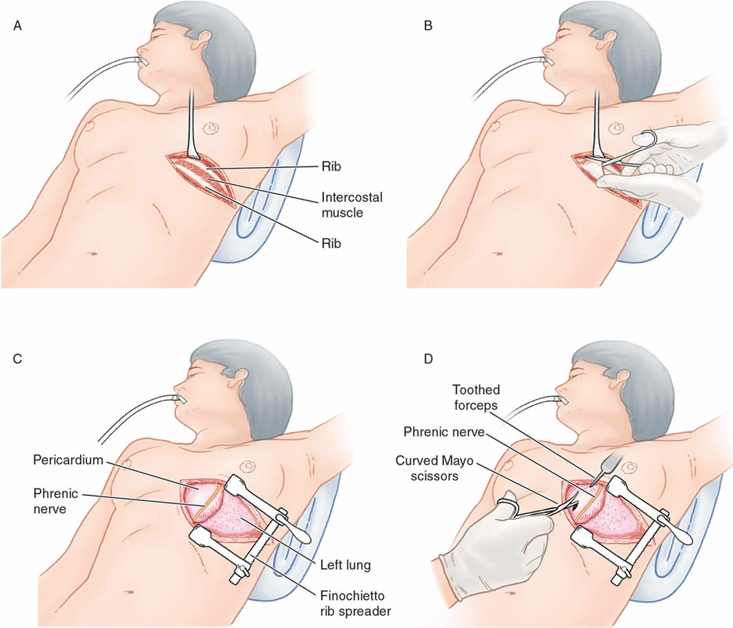Exploring Thoracotomy: Procedure, Recovery, and Considerations