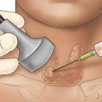 Thyroid Biopsy: Understanding the Procedure and Its Significance thyroid biopsy