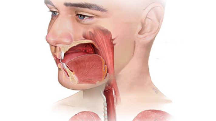 tonsil cancer