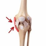 Navigating a Torn MCL Injury: Causes, Symptoms, and Effective Recovery Strategies torn mcl