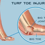 Turf Toe: Causes, Symptoms, and Effective Treatment Strategies turf toe