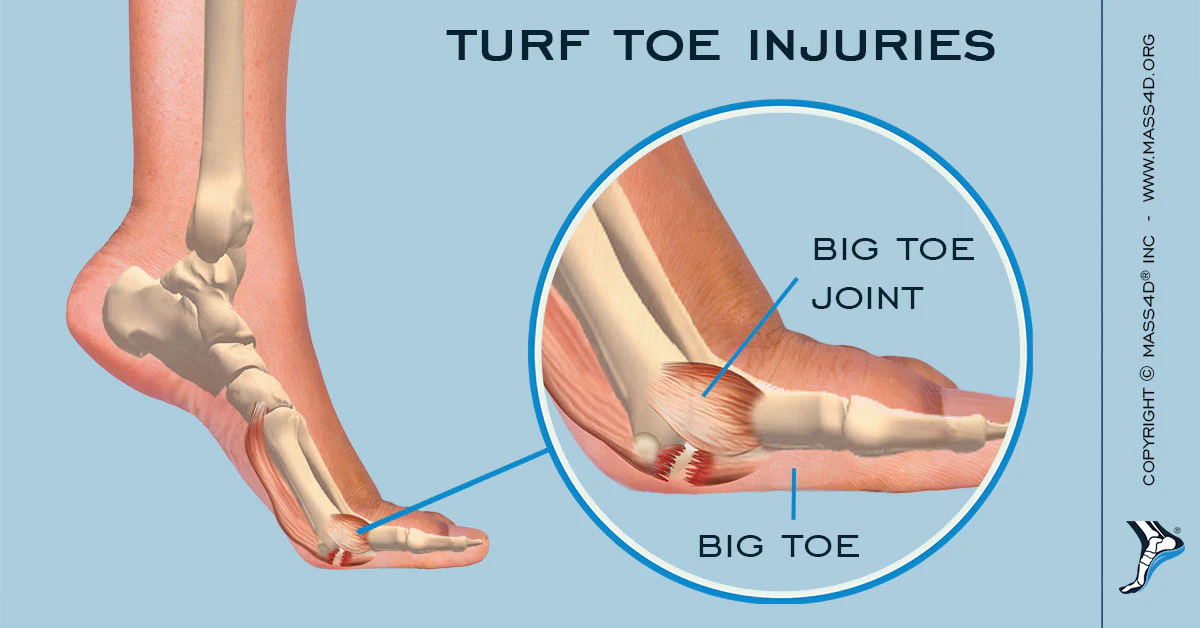 Turf Toe: Causes, Symptoms, and Effective Treatment Strategies ...