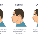 Unveiling the Impact of Underbite: Causes, Effects, and Treatment underbite