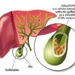 Exploring Ursodiol: Uses, Benefits, and Considerations ursodiol